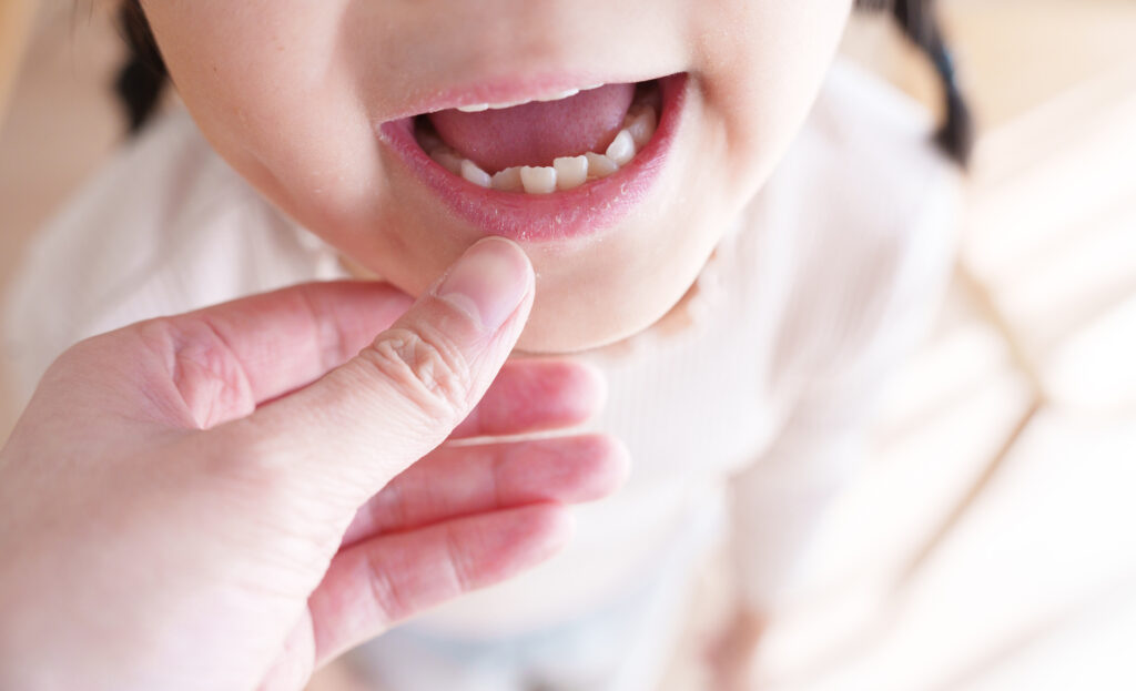 歯並びが悪い子供の口元