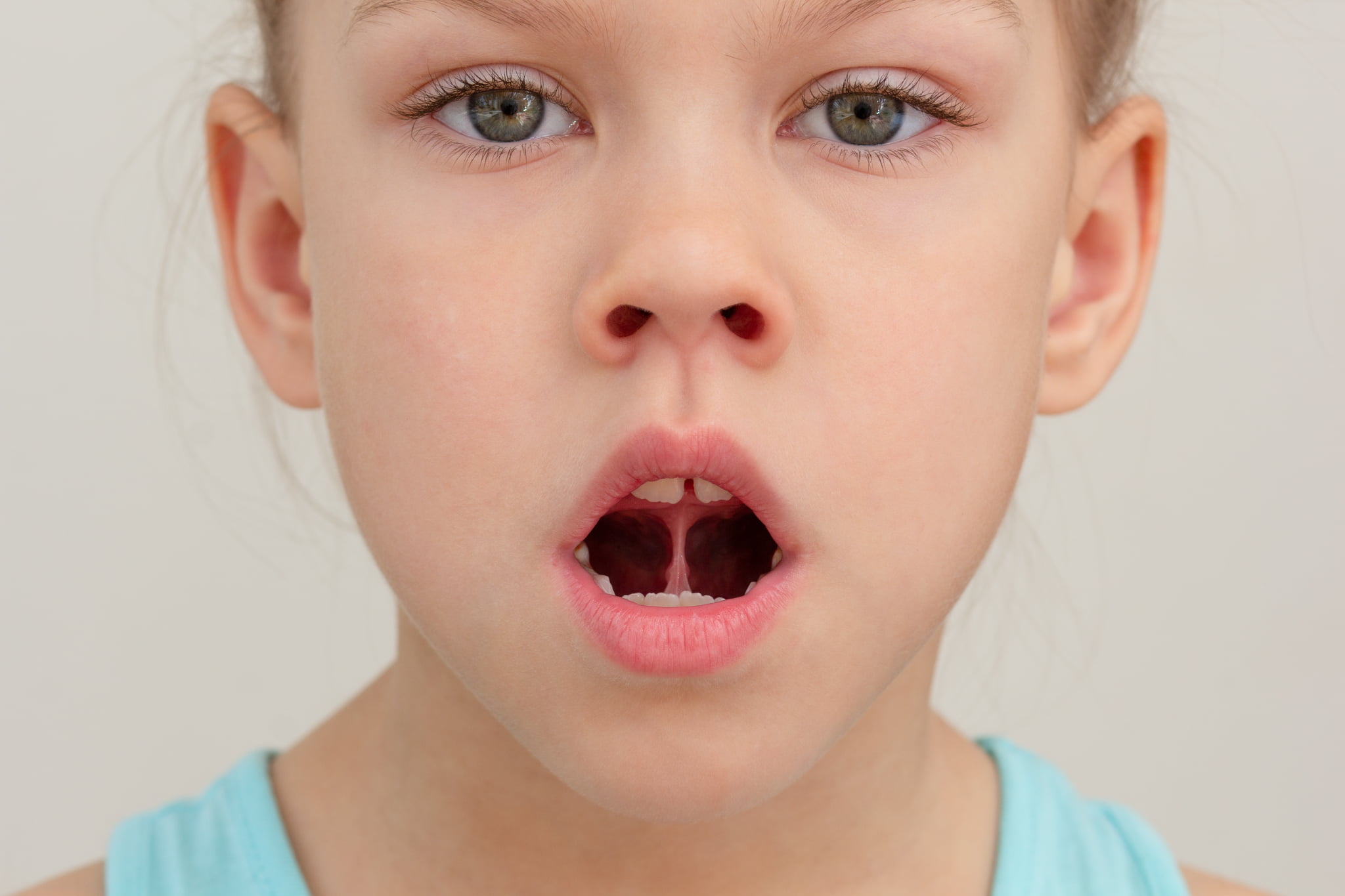 MFT(口腔筋機能療法)で歯ならびを整えようとしている子どものイメージ
