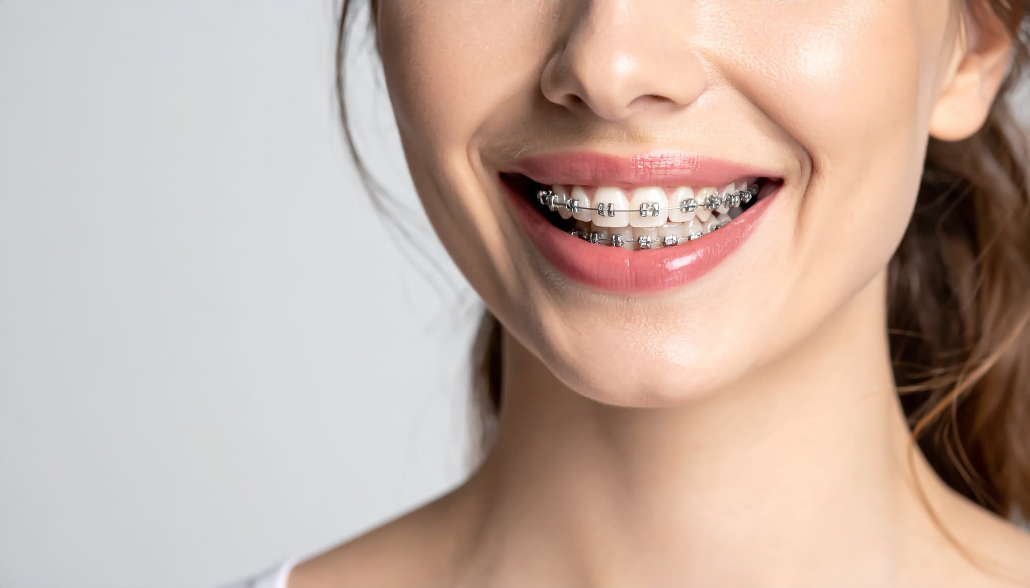 ワイヤー矯正をしてい女性性