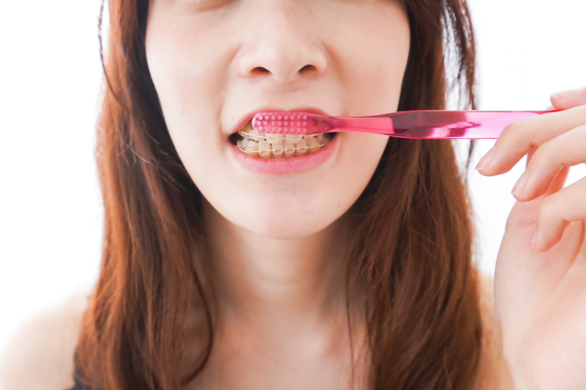 ワイヤー矯正中の女性が歯磨きをする様子