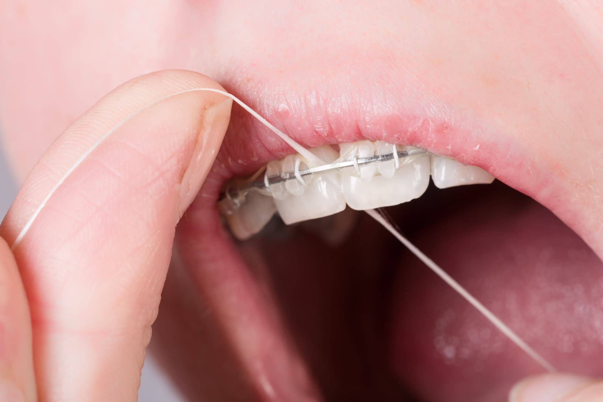 ワイヤー矯正中にフロスを使用してケアをする様子