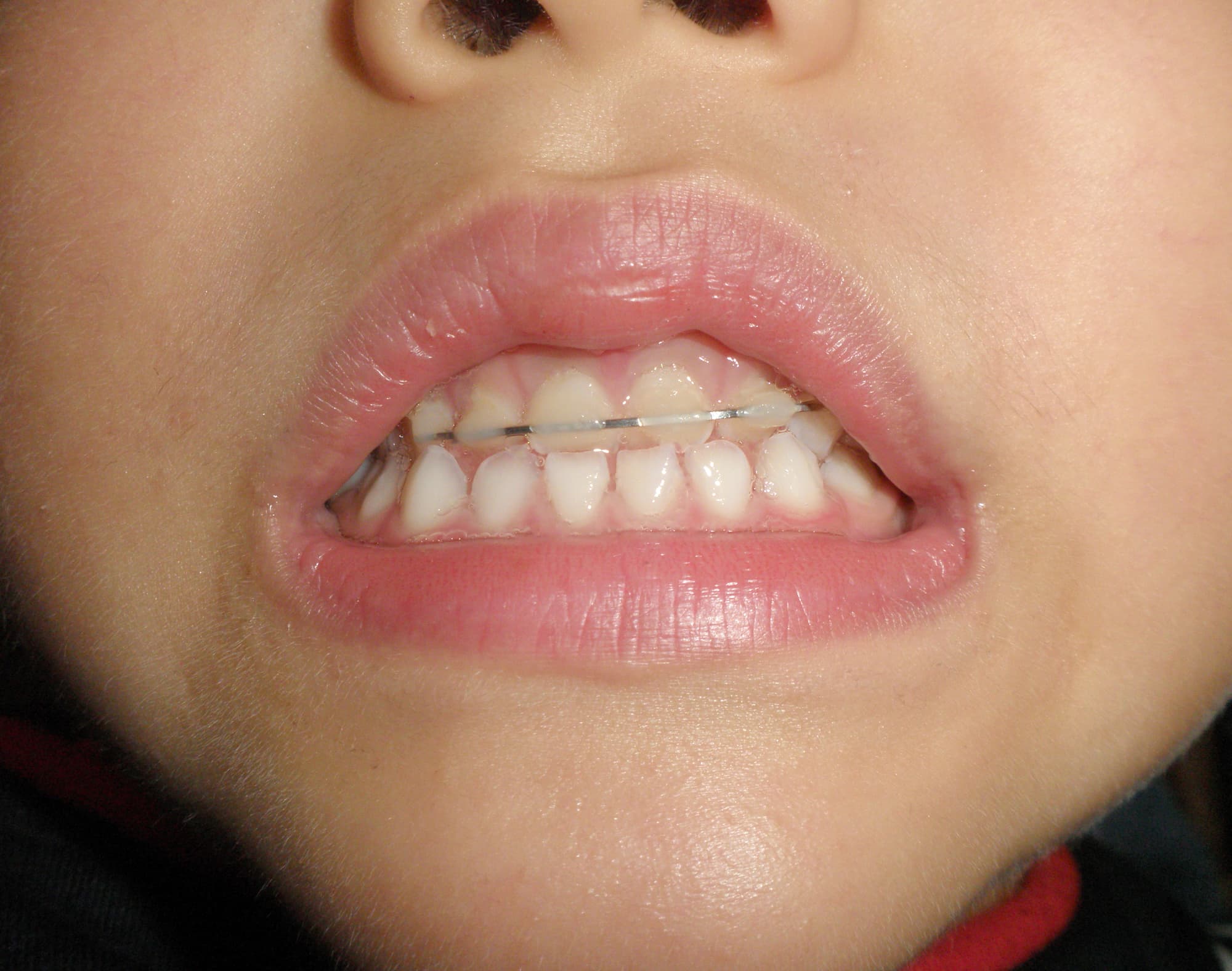 受け口を矯正している子どもの口元