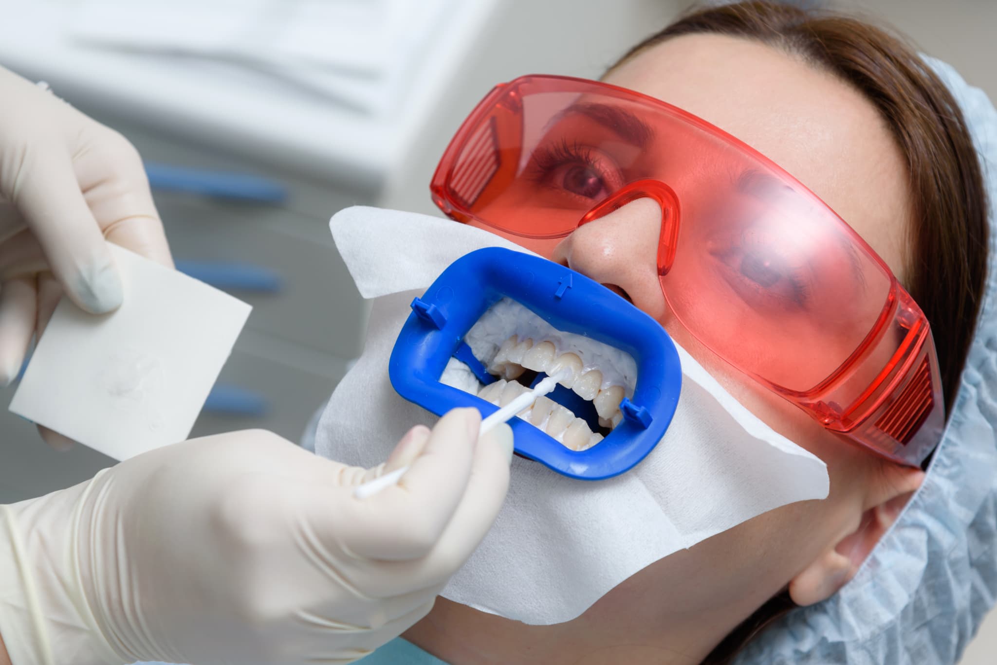 オフィスホワイトニングで歯に薬剤を塗布されている患者