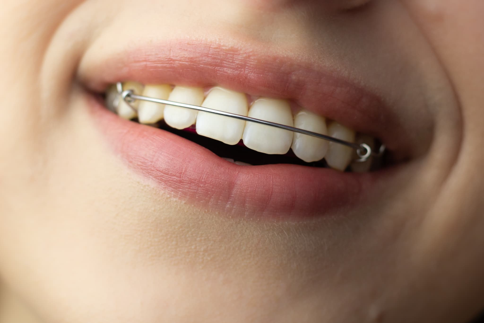 リテーナーを正しく装着した口元