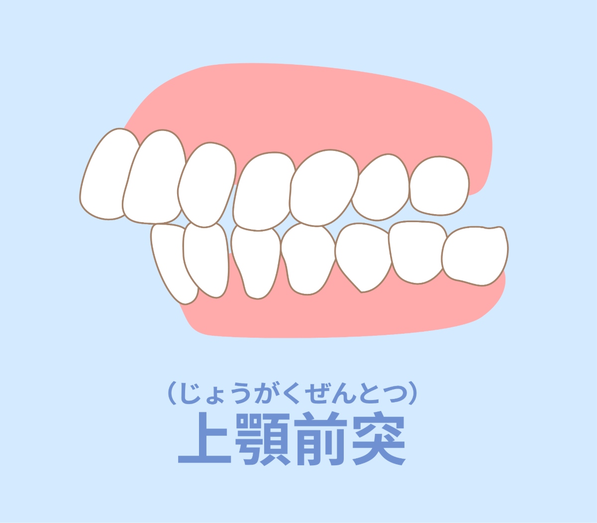 ゴムかけが必要になる上顎前突のイメージ
