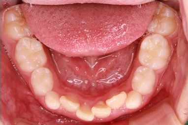 乳歯の歯並び②