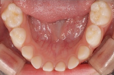 すきっ歯の歯並び①