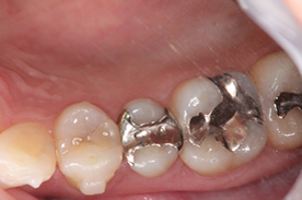 矯正治療で歯を抜かなければならないかどうかを左右するセレックの活用例 ビフォー