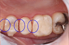 矯正治療で歯を抜かなければならないかどうかを左右するセレックの活用例 アフター